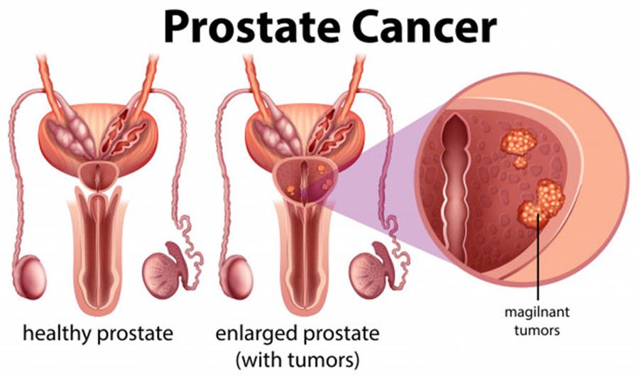 ¿Cáncer a temprana edad?